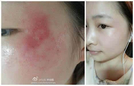 脸上为什么会得皮炎 为什么脸上会的皮炎？