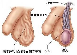 精索静脉曲张手术治疗 精索静脉曲张的原因 VC的症状与手术治疗