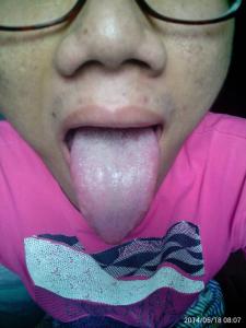 舌癌的早期症状图片 舌状的