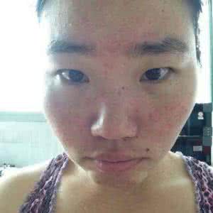 脸上的痘印怎么修复 脸上的痘印怎么修复 痘印的修复方法