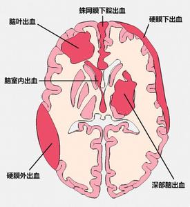 脑出血最常见的部位是 各部位出血5方