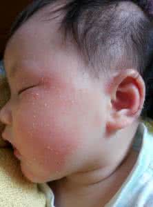 儿童湿疹好的治疗方法 湿疹怎样才能治疗好 怎样才能治疗儿童湿疹