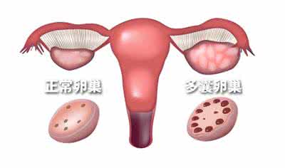 多囊卵巢囊肿综合症 多囊卵巢综合症的症状 怎么治疗多囊卵巢 多囊患者有哪些症状