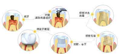 牙齿神经痛如何治疗 牙齿神经痛 在家中治疗它的方法