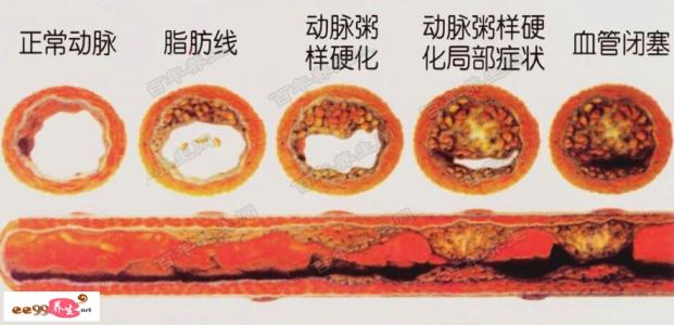 动脉粥样硬化闭塞症 图文：闭塞性动脉粥样硬化验方