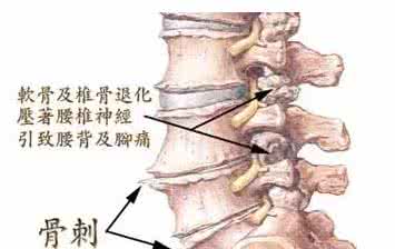 骨质增生和骨刺的区别 治疗骨刺和骨质增生 我来说说自己父亲如何去除骨刺（骨质增生）的痛苦经历