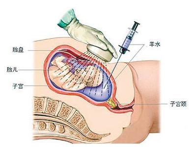 羊水穿刺 羊水穿刺参考范围