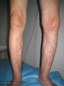 下肢静脉曲张验方 国宝秘方：下肢静脉曲张及急性湿疹特效验方湿疹汤