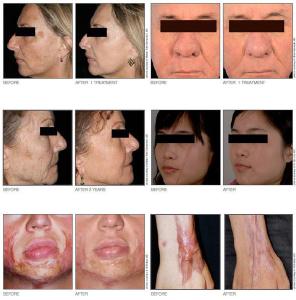 激光治疗痤疮有用吗 痤疮种类有哪些 激光可以治疗痤疮吗