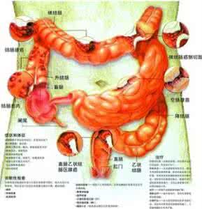 结肠癌转移肺癌生存期 结肠癌 偏方 大庆一患者贡献治疗胃癌、肺癌、结肠癌偏方