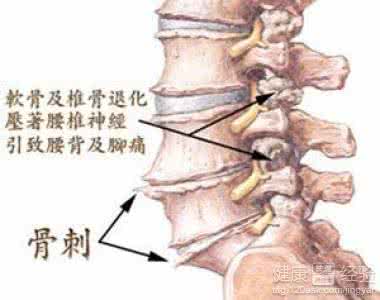 骨质增生患者 骨质增生患者 骨质增生患者福音来了!