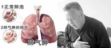 肺气肿病理分型 为什么会得肺气肿  病理病因早知道