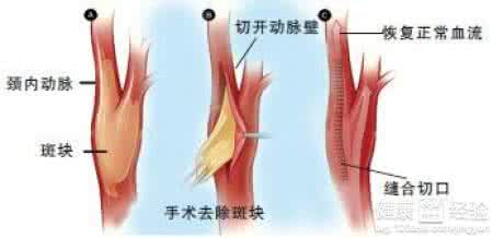 颈动脉硬化如何治疗 颈动脉硬化如何治疗 颈动脉硬化的治疗方式