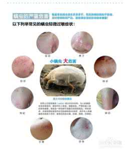 螨虫怎么去除简单方法 螨虫怎么去除简单方法 关于螨虫的去除方法