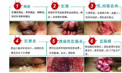 大便出血 鲜红 无痛 上大便出血 无痛性大便出血常见于3种疾病