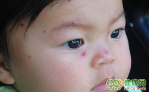 水痘疫苗什么时候打 水痘疫苗什么时候打 孩子打了疫苗就不会再出水痘?错!