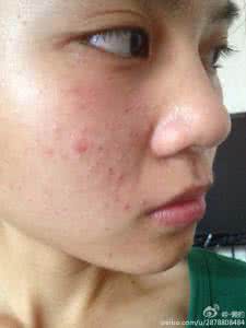 闭合性粉刺吃什么药 长闭合性粉刺的原因，闭合性粉刺要吃什么好