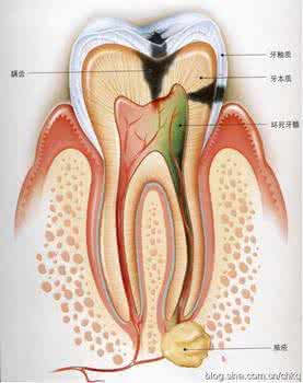 实用西医验方 牙髓炎验方（西医所说的牙神经发炎），止痛以秒计算！