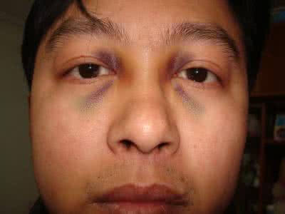 鼻梁疼怎么回事 鼻梁头部疼怎么回事?