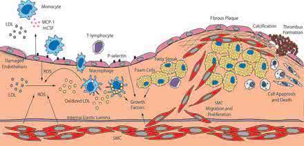 动脉粥样硬化斑块 颈动脉粥样硬化斑块 动脉粥样硬化斑块 这些事你得明白
