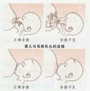 乳头皲裂怎么快速治愈 如何预防乳头皲裂
