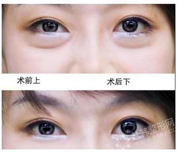 祛眼袋大概需要多少钱 祛眼袋大概多少钱 去眼袋大概多少钱