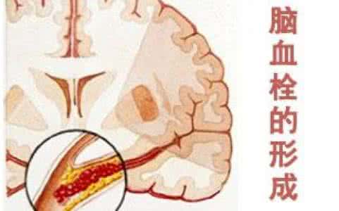 脑血栓后遗症的治疗 脑血栓后遗症 脑血栓后遗症的饮食