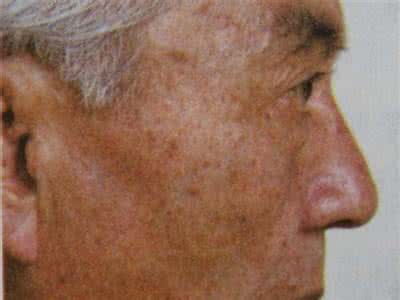 如何防治老年斑 防治老年斑验方10则