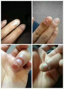 灰指甲怎么治好的快 灰指甲怎么治好的?