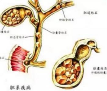 严重失眠偏方大全秘方 治疗胆结石偏方 治疗胆囊结石偏方大全