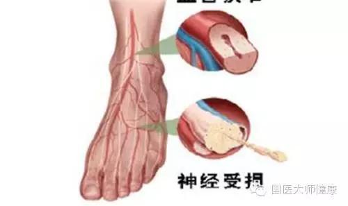 血管堵塞是什么原因 血管是如何一步步堵塞的?教你一招自测血管堵没堵!快测测吧!