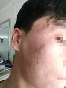 人中长痘痘 背后长痘痘 人背后长痘叫什么?