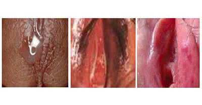 淋病能治愈吗 性病淋病能治愈吗？