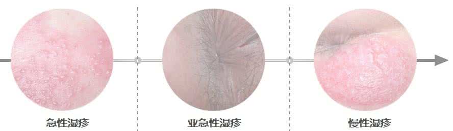 肛门湿疹的治疗方法 肛门湿疹怎么治 这治疗方法治疗肛门湿疹好