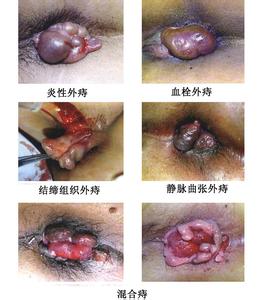 痔疮的原因及治疗 什么是痔疮 痔疮的原因及治疗