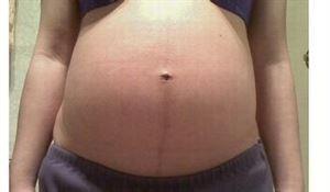 妊娠线判断生男生女 从“妊娠线”即可判断生男生女——真的很准很准!