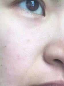 脸上反复长闭合性粉刺 脸上长闭合性粉刺怎么办