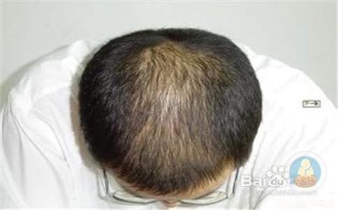 局部脱发是什么原因 局部脱发是什么原因 脱发怎么办