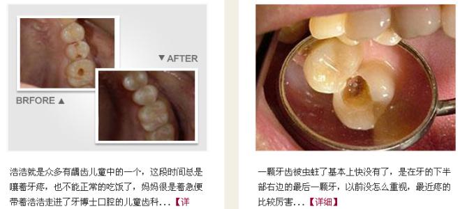 树脂补牙材料能用几年 补牙树脂材料多少钱 补牙材料知多少 如何选择补牙材料