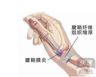 大拇指腱鞘炎能自愈吗 如何才能让腱鞘炎自愈起来呢?
