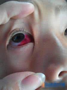 眼睛会哭瞎吗 眼睛会哭瞎吗 眼睛为什么会哭瞎?