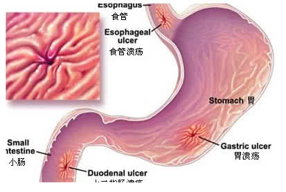 治疗胃溃疡的特效药 胃溃疡的最佳治疗方法