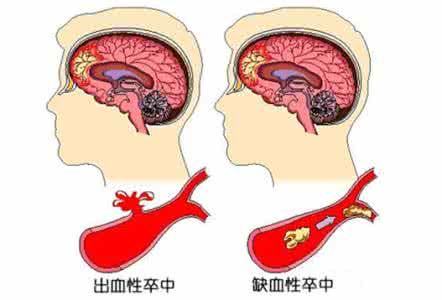 脑出血偏瘫偏方 脑出血偏方