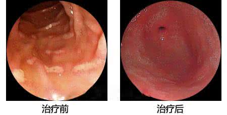 慢性肠炎 慢性肠炎   20150715