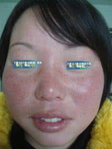 雀斑能去掉吗找佰肌净 雀斑能去掉吗？雀斑临床表现