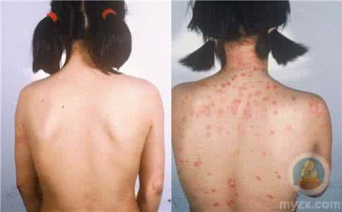 银屑病的临床表现 银屑病症状 它有哪些临床表现