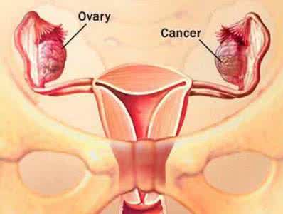 卵巢癌的检查方法 卵巢癌的检查方法 早日发现卵巢癌的方法