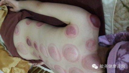 真空拔罐 后注意事项 你知道拔罐后会怎样么？真的太吓人了