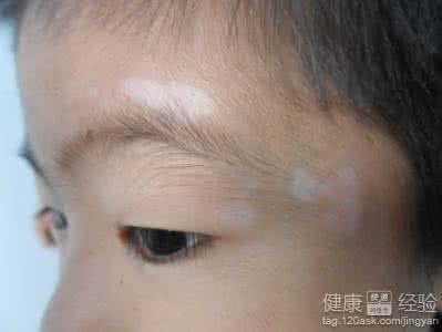 脸上长白斑该擦什么药 脸上长白斑 脸上长白斑用什么药?