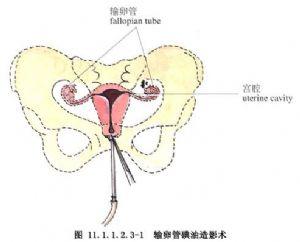 子宫输卵管造影很疼吗 子宫输卵管造影 输卵管造影疼吗